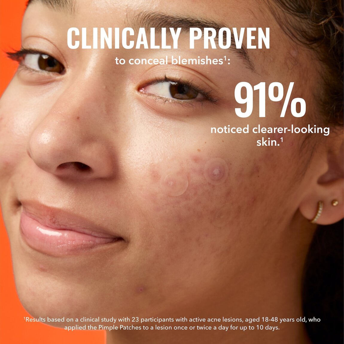 pimple-patches-g0 zb_p.jpg