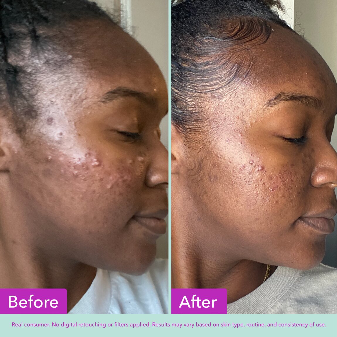 acne-foaming-cleanser-r5 zb_p.jpg